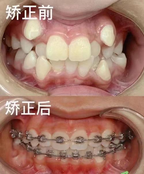 牙齿整形与矫正有何区别？如何选择适合自己的方式？-图1