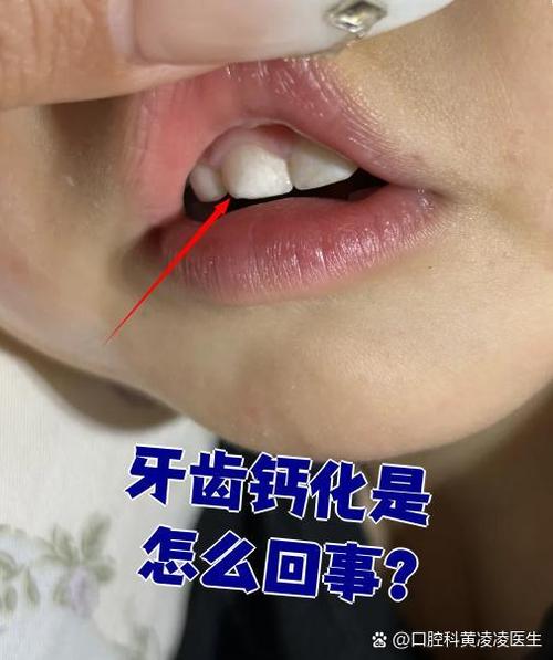 牙齿矫正后钙化-图1