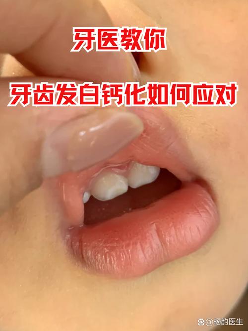 牙齿矫正后钙化-图2