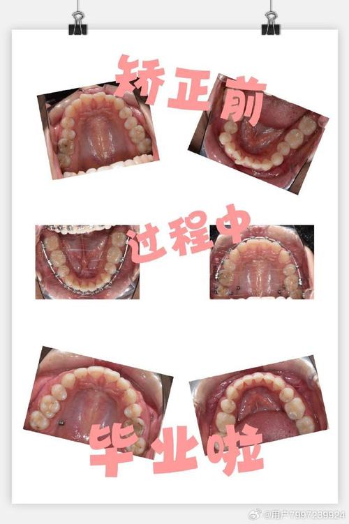 矫正牙齿开口图是什么?如何通过它看懂矫正效果?-图2 矫正牙齿开口图是什么?如何通过它看懂矫正效果?-图2