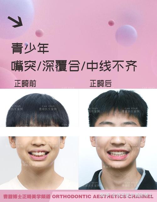 矫正后牙齿为何还不齐？-图3