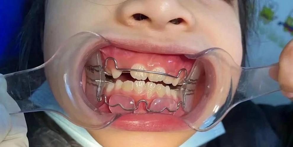 小孩能做牙齿矫正吗？最佳年龄是几岁？-图1