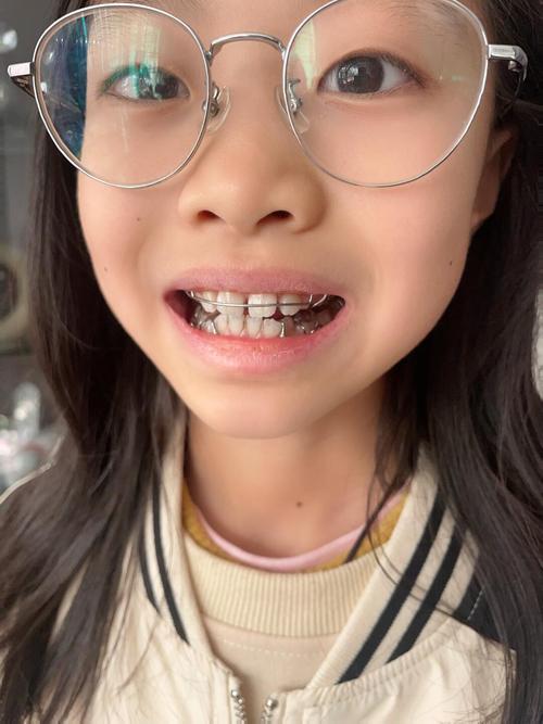 小孩能做牙齿矫正吗？最佳年龄是几岁？-图3