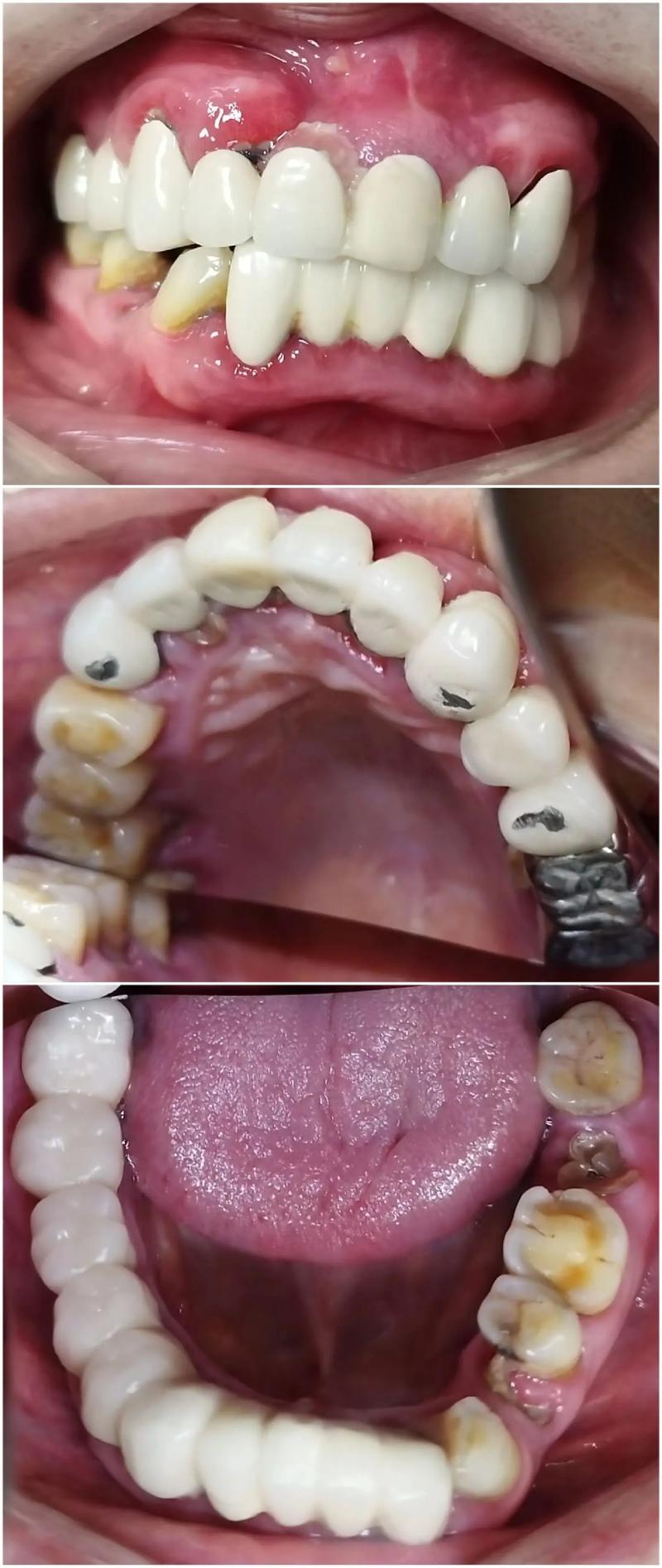 矫正牙齿为何会被腐蚀？-图2
