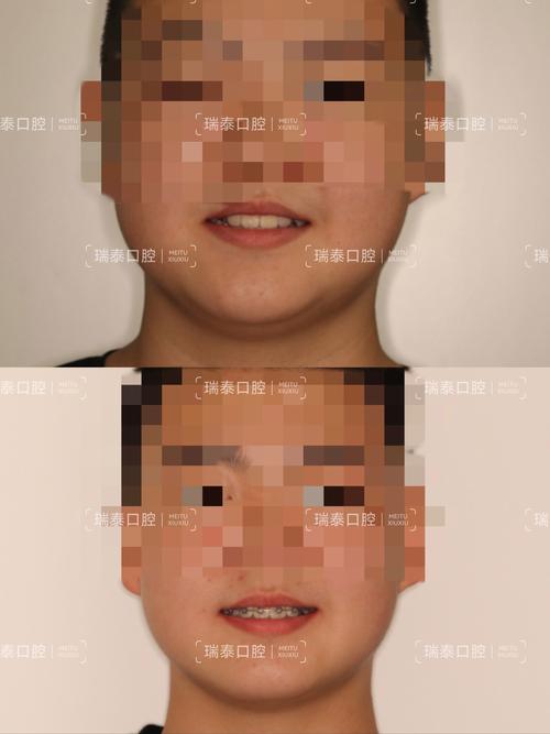 牙齿矫正自信了-图1