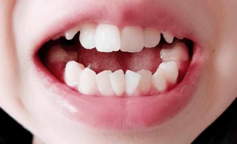 牙齿矫正自信了-图3