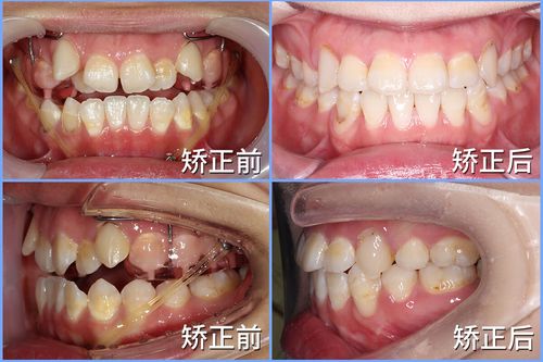 牙齿矫正后为何会错位？原因分析与处理方法-图1