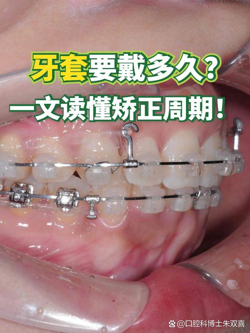 牙齿矫正换牙套-图2