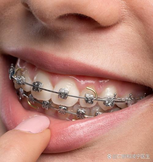 矫正期牙齿松动-图2