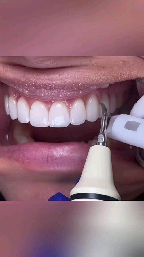 矫正牙齿用瓷贴面？效果和传统矫正有何区别？-图2