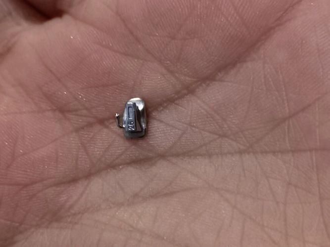 牙齿矫正后牙齿脱落?这是什么原因导致的?该如何处理?-图1 牙齿矫正后牙齿脱落?这是什么原因导致的?该如何处理?-图1