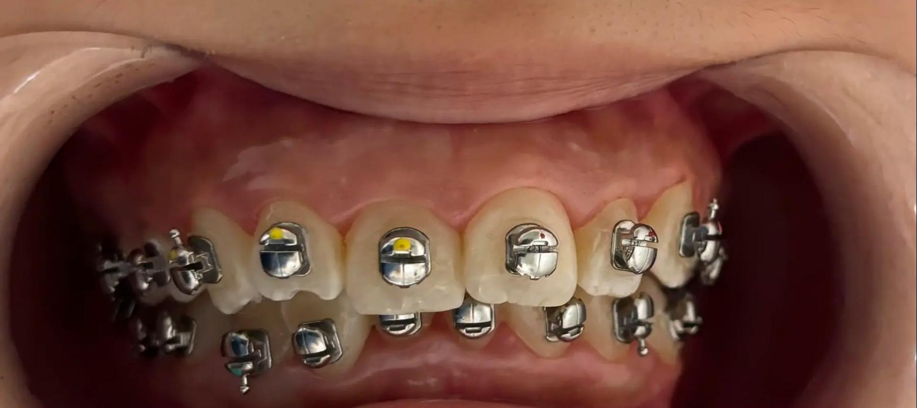 瑞典牙齿矫正有何独特优势？效果和费用如何？-图1