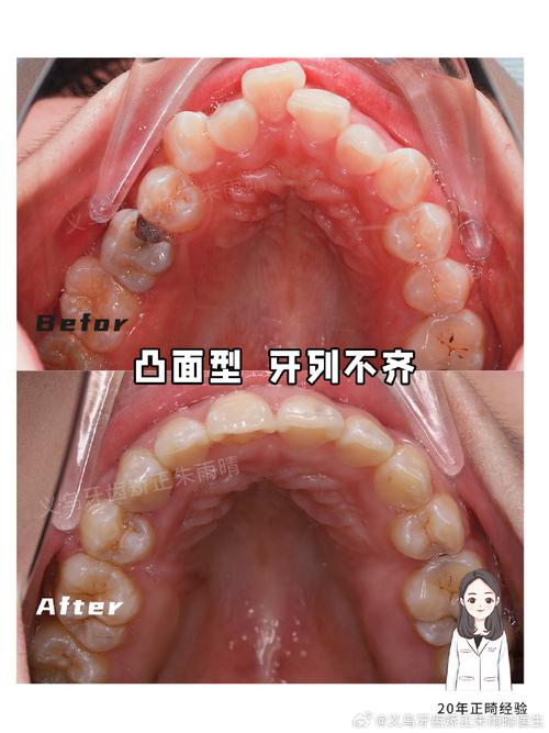 矫正牙齿不配合?为什么?怎么办?原因和方法都在这?-图3 矫正牙齿不配合?为什么?怎么办?原因和方法都在这?-图3