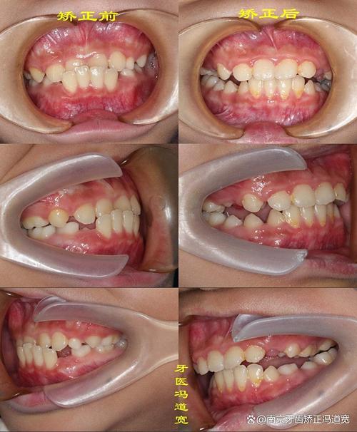 南京牙齿矫正后效果能维持多久?需注意哪些护理事项?-图1 南京牙齿矫正后效果能维持多久?需注意哪些护理事项?-图1