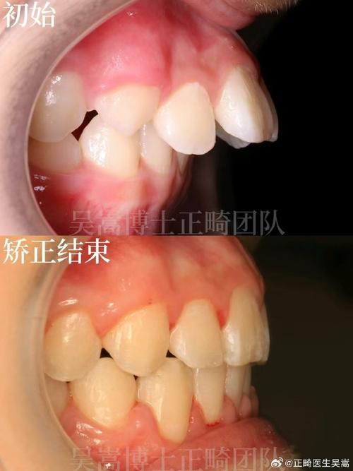 南京牙齿矫正后效果能维持多久?需注意哪些护理事项?-图2 南京牙齿矫正后效果能维持多久?需注意哪些护理事项?-图2