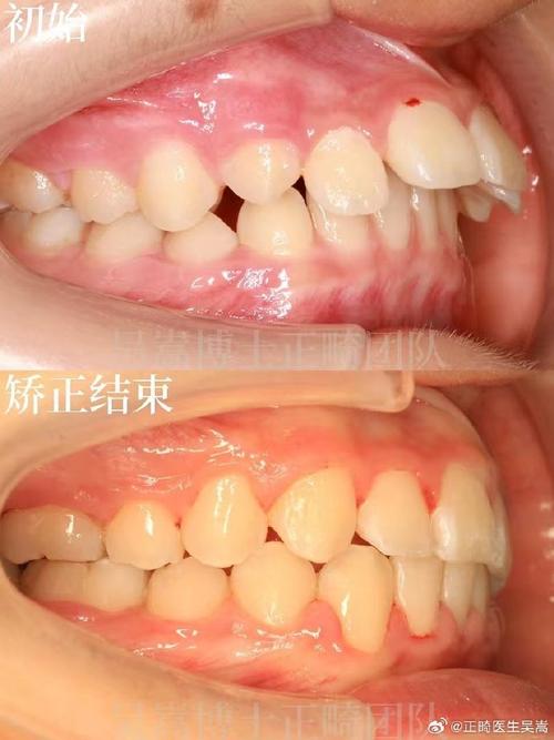 南京牙齿矫正后效果能维持多久?需注意哪些护理事项?-图3 南京牙齿矫正后效果能维持多久?需注意哪些护理事项?-图3