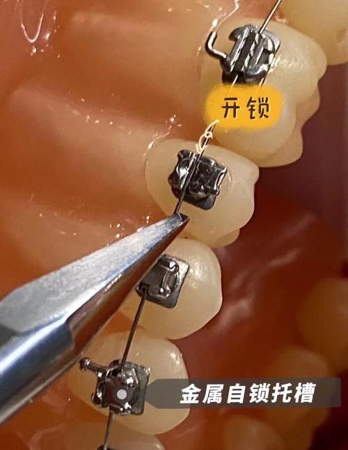 钢托槽矫正牙齿-图2 钢托槽矫正牙齿-图2