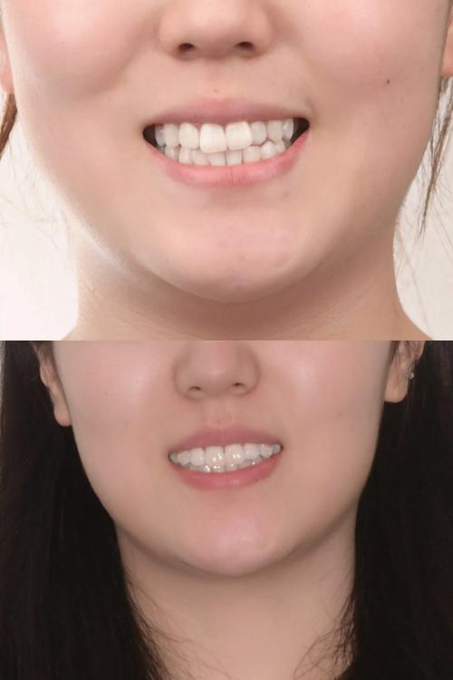 矫正牙齿导致嘴变大，是正常现象吗？-图1