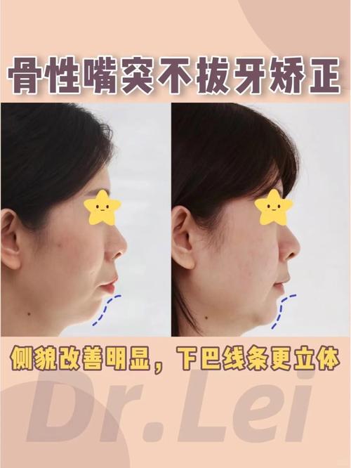 矫正牙齿导致嘴变大，是正常现象吗？-图3