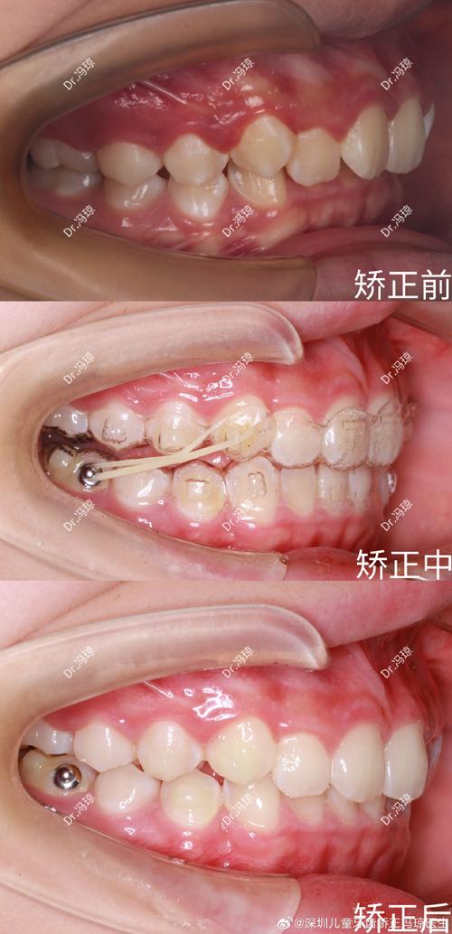 牙齿不严重矫正有必要吗?效果真的好吗?-图2 牙齿不严重矫正有必要吗?效果真的好吗?-图2