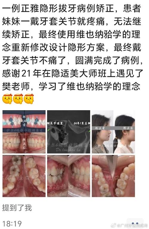 矫正牙齿对讲师的职业形象和授课效果会产生哪些影响?-图1 矫正牙齿对讲师的职业形象和授课效果会产生哪些影响?-图1