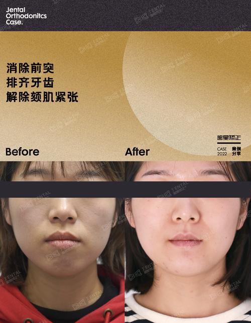 周博士牙齿矫正-图1 周博士牙齿矫正-图1