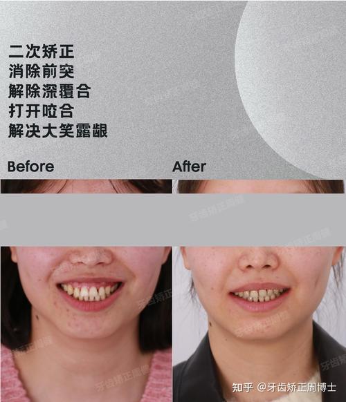 周博士牙齿矫正-图2 周博士牙齿矫正-图2