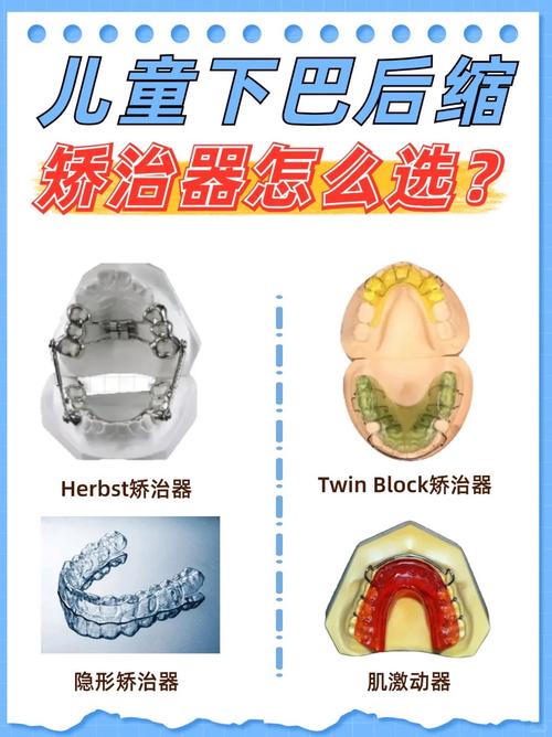 矫正牙齿器品种有哪些?常见类型有何区别?-图2 矫正牙齿器品种有哪些?常见类型有何区别?-图2