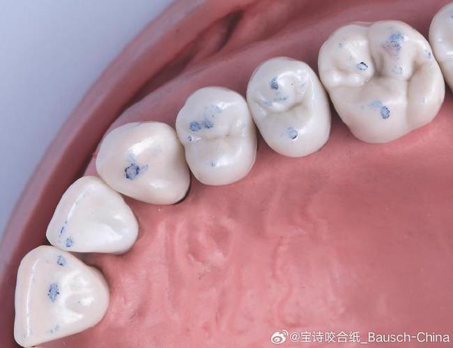牙齿矫正期间，用纸巾清洁牙齿和牙套有哪些技巧？-图2