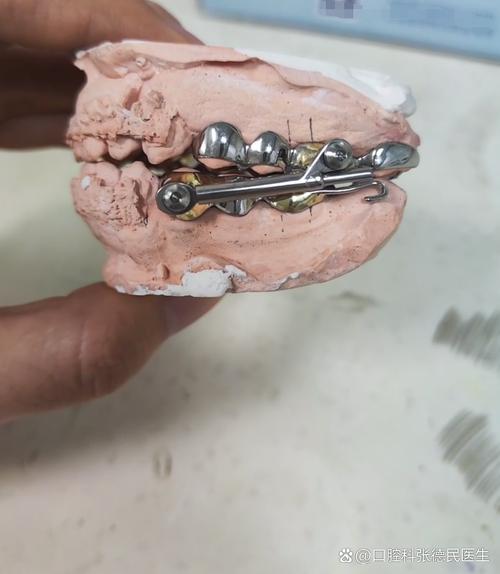 MRT牙齿矫正是什么？效果好吗？-图2