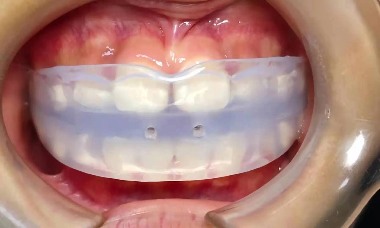矫正牙齿ETA-图1