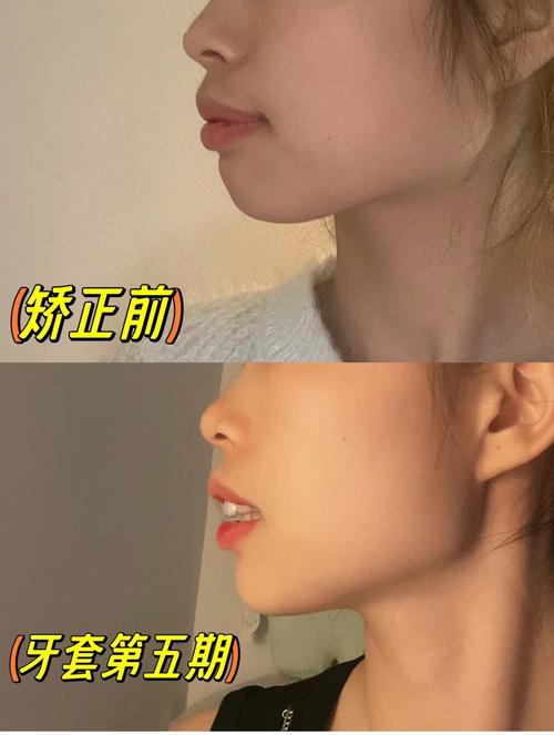 矫正牙齿 笑容-图3