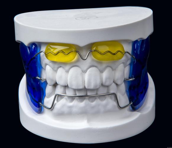 牙齿矫正器矫正-图2