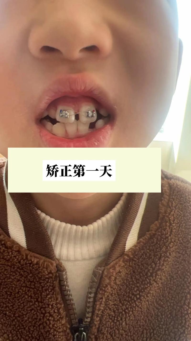 智齿矫正牙齿真的能让牙齿变整齐吗？要注意哪些问题？-图2
