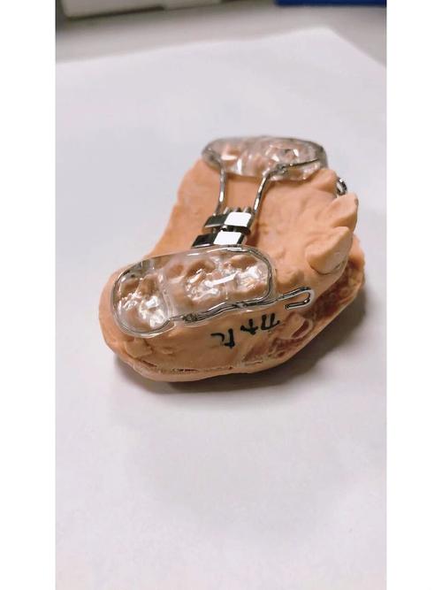 牙齿反合矫正器效果如何?适用哪些人群?-图1 牙齿反合矫正器效果如何?适用哪些人群?-图1