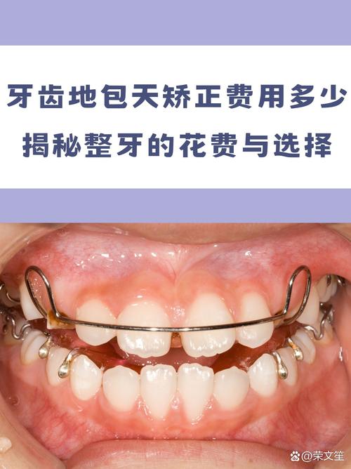 牙齿反合矫正器效果如何?适用哪些人群?-图3 牙齿反合矫正器效果如何?适用哪些人群?-图3