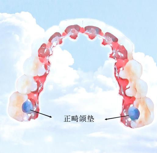 矫正牙齿的合垫-图1