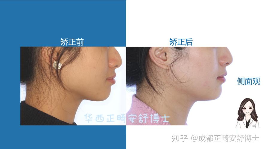 成都市牙齿矫正-图2 成都市牙齿矫正-图2