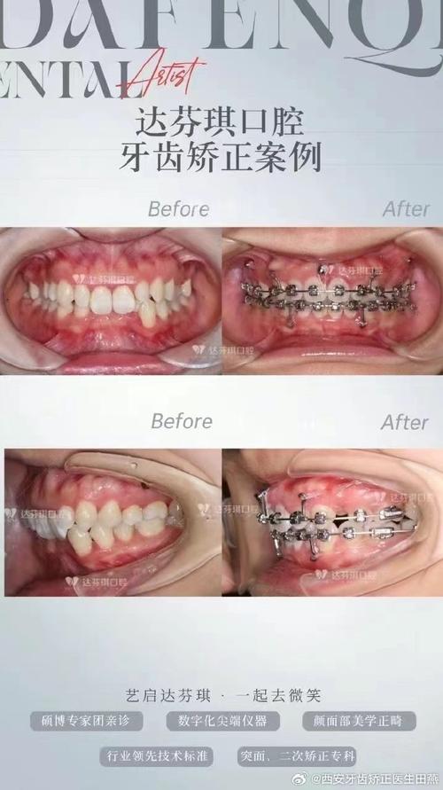 矫正深覆合牙齿有哪些有效方法？-图2