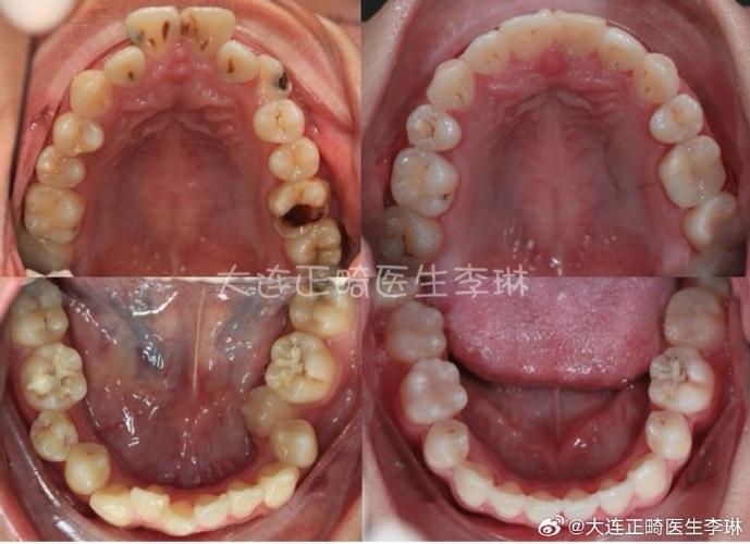 矫正拔牙的牙齿-图2