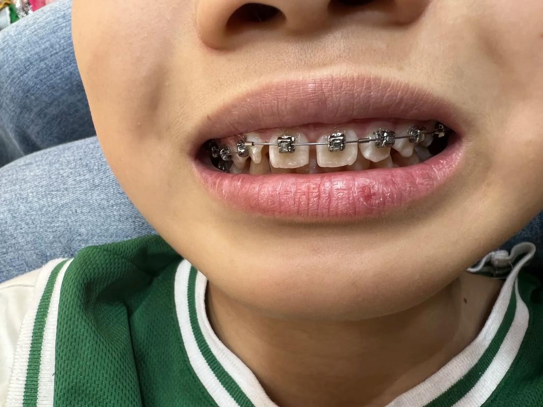 矫正牙齿为何会引发龋齿风险？-图2