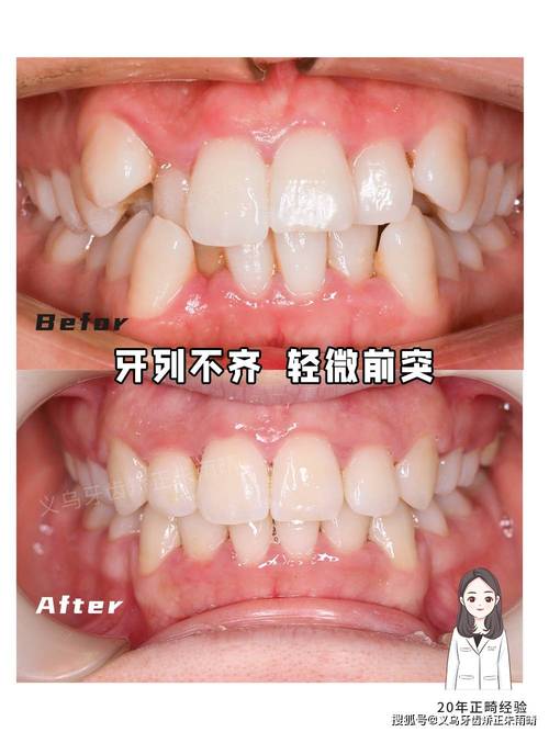 牙齿畸形不矫正，会引发哪些健康隐患？-图3