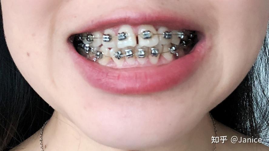 南京矫正牙齿，医院怎么选？费用要多少？效果如何？-图1