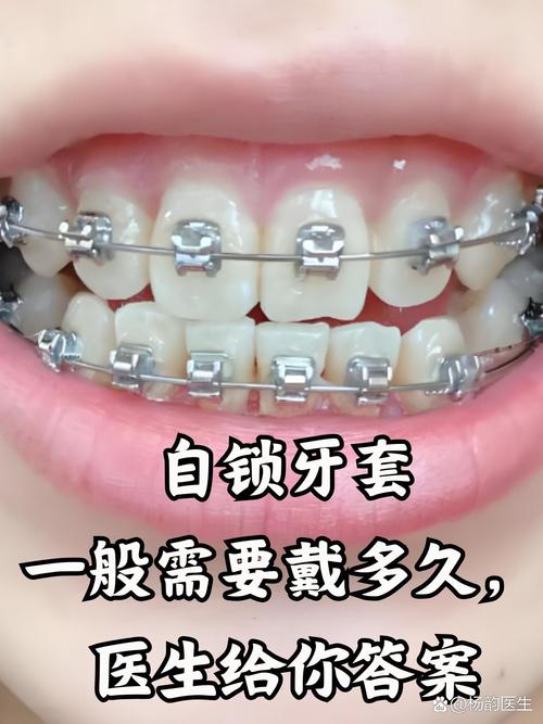 矫正牙齿 自锁-图2 矫正牙齿 自锁-图2