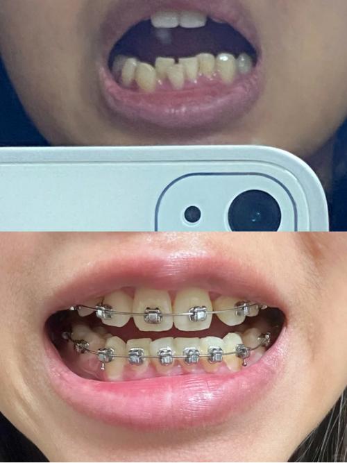 矫正牙齿交流群-图2 矫正牙齿交流群-图2