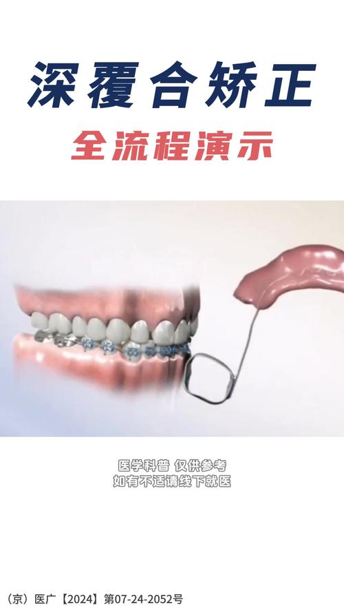 牙齿矫正过程是怎样的？关键步骤和注意事项有哪些？-图3