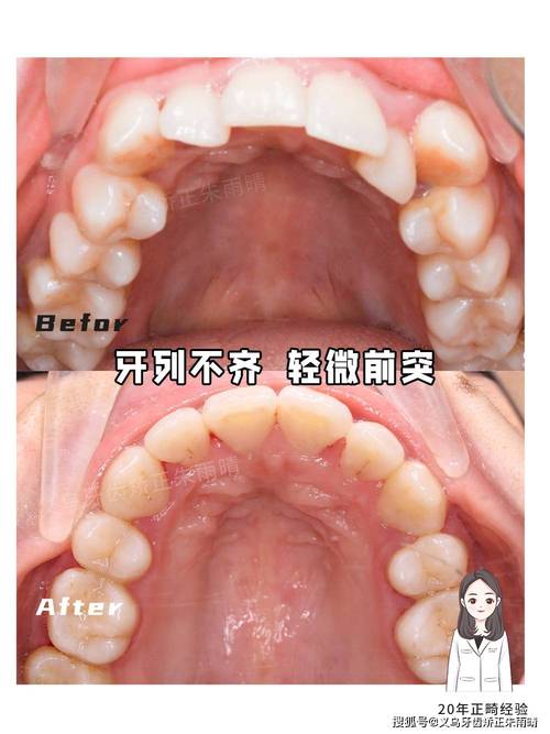 牙齿矫正常见问题有哪些？效果、时间与风险如何平衡？-图2