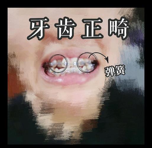 牙齿矫正上弹簧-图1