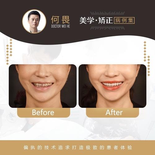 爱优牙牙齿矫正效果怎么样？适合哪些人做呢？-图1