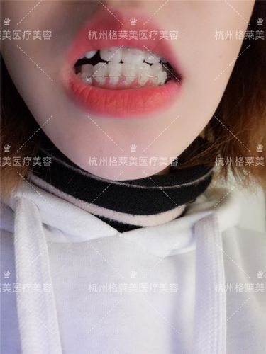 牙齿矫正格莱美-图2